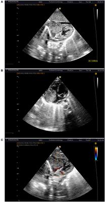 Cardiac Myosarcoma in a Newborn Infant—A Case Report and Literature Review